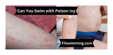 Can You Swim with Poison Ivy? Exploring the Unlikely Connection Between Aquatic Adventures and Skin Irritations