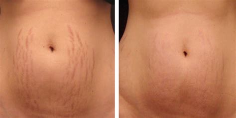 How Much Does Stretch Mark Removal Cost: Exploring the Price of Vanishing Lines